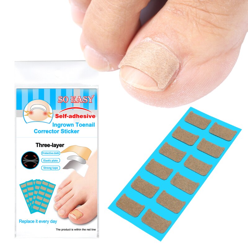 Ingrown Toenail Correct Patches™