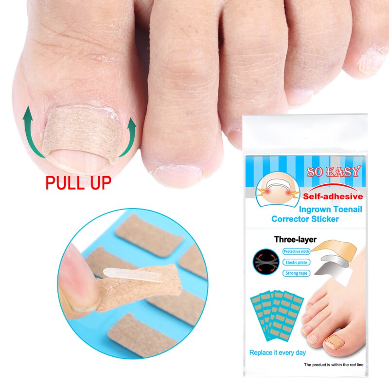 Ingrown Toenail Correct Patches™