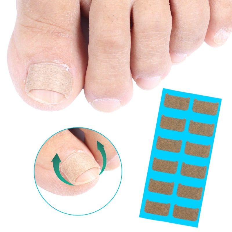 Ingrown Toenail Correct Patches™